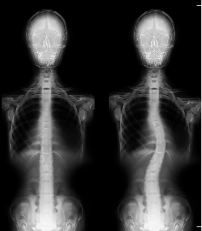 Scoliosis Treatment In Fishkill